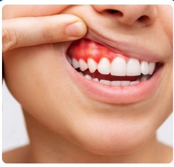 Oral Defense Benefit